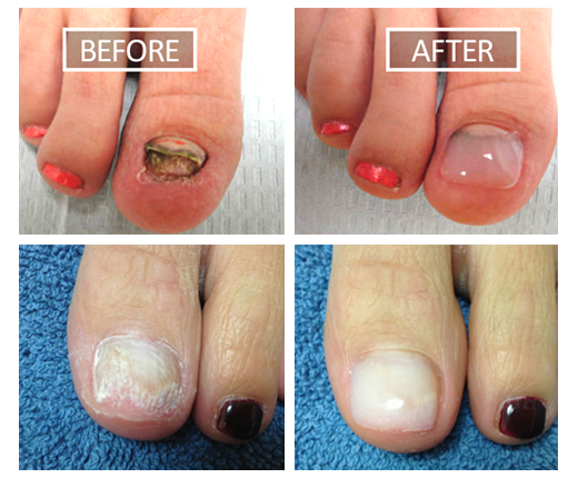 Dallas Toenail Fungus Treatment | Dallas Noveon Toenail Laser TreatmentNTFA